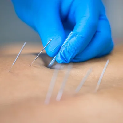 Dry Needling Naturaltherapy